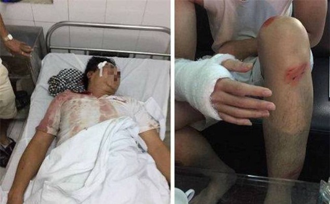 Côn đồ hành hung dã man lúc nửa đêm, 4 người ở Hà Nội nhập viện