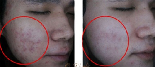 mach ban 3 cach tri  seo, vet tham mun don gian hieu qua hon my pham tien trieu - 9