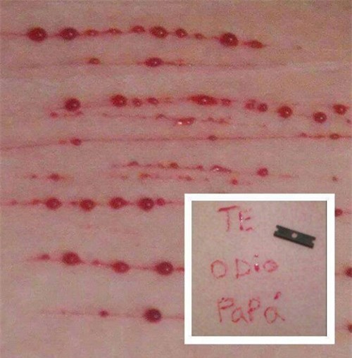 Cô bé tự lấy dao rạch khắp cơ thể và nỗi đau bị bố đẻ xâm hại từ năm 4 tuổi - Ảnh 1.