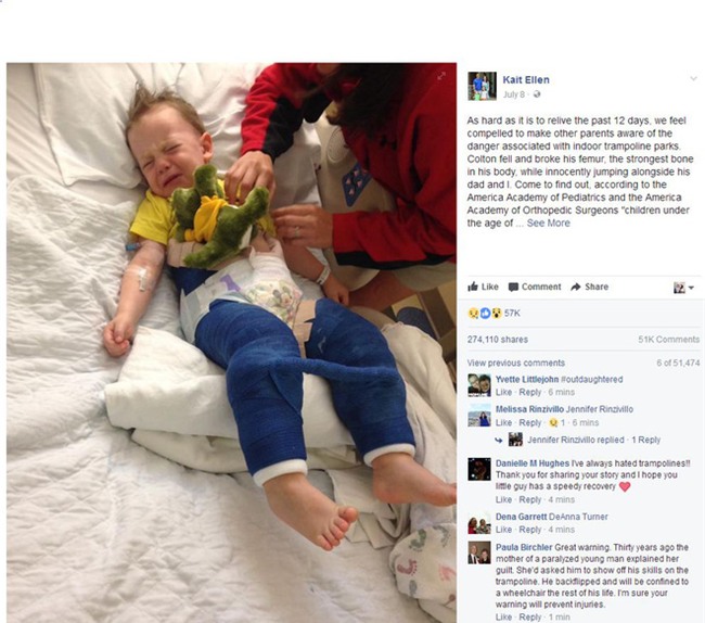 Bé trai gãy cả 2 chân sau khi chơi bạt nhún, các bậc phụ huynh tuyệt đối không cho con nhỏ chơi trò này - Ảnh 1.