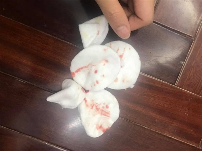 Liều mình làm tận 2 lần, mẹ trẻ tiêm filler mũi sau 2 tuần bóp ra đầy dịch vàng lẫn cả máu - Ảnh 4.