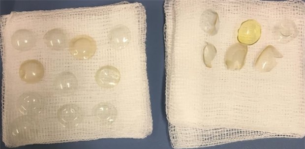 Phẫu thuật đục thủy tinh thể, bác sĩ tá hỏa khi phát hiện trong mắt bệnh nhân có tới 27 kính áp tròng - Ảnh 1.