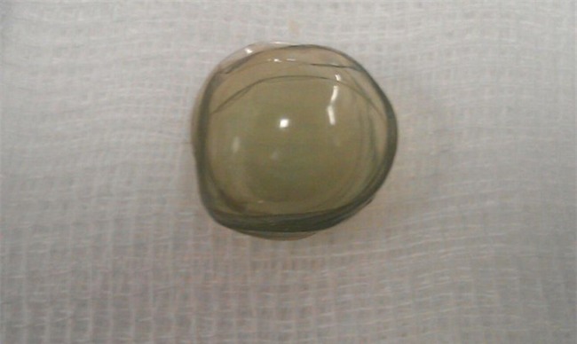 Phẫu thuật đục thủy tinh thể, bác sĩ tá hỏa khi phát hiện trong mắt bệnh nhân có tới 27 kính áp tròng - Ảnh 2.