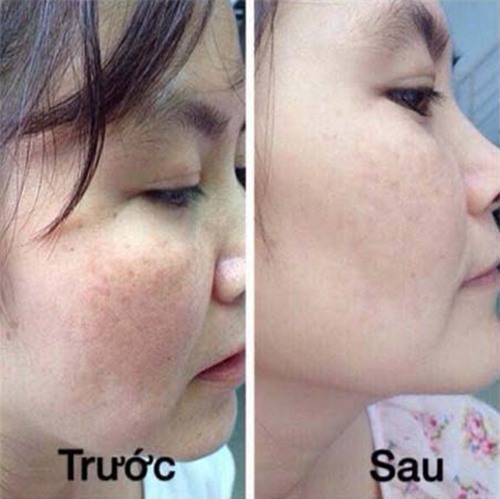 dap mat na tra xanh cho moi loai da lam trang va tri nam cuc hieu qua - 8