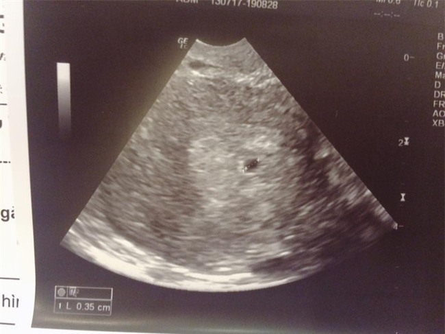 Mang thai 5 tuần, cô gái trẻ choáng váng khi biết mẹ đẻ nghe lời thầy bói, lạnh lùng bắt phá thai - Ảnh 3.