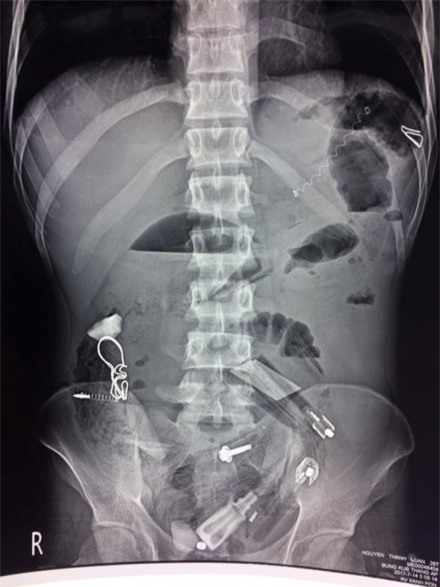 Lay but bi, bat lua, lo xo... ra khoi da day benh nhan ngao da hinh anh 1