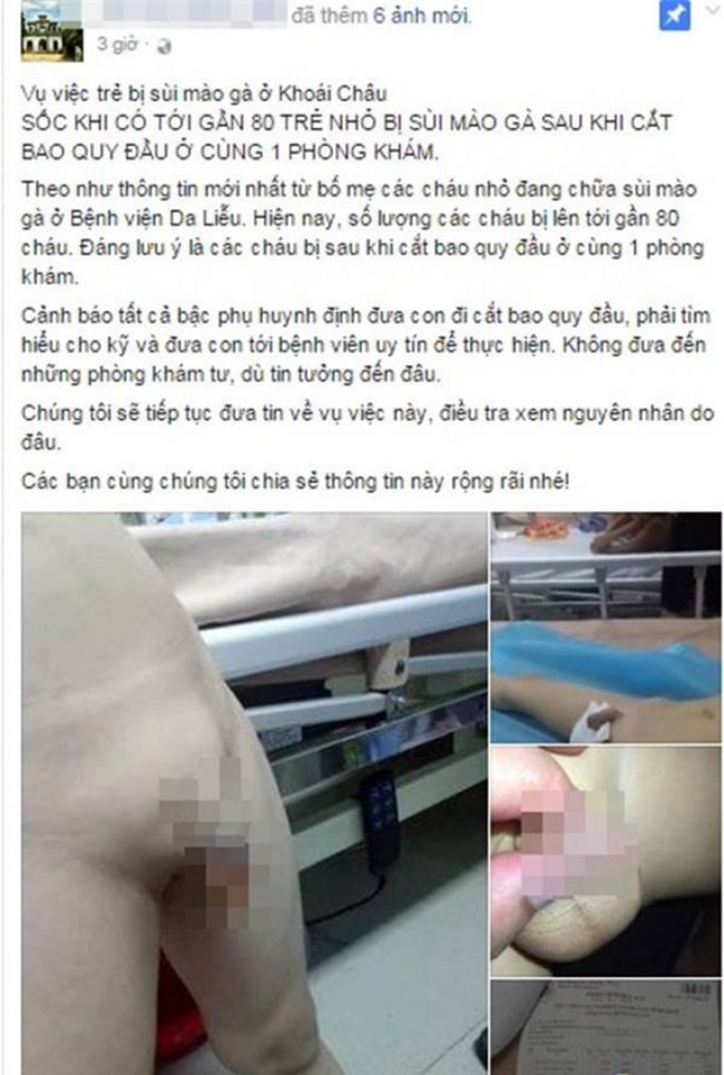 sùi mào gà, Hưng Yên, trẻ em