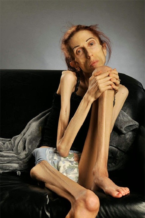 hanh trinh lot xac than ky cua co gai da boc xuong tro thanh thien nga xinh dep - 3