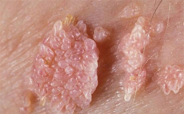 sùi mào gà, bệnh sùi mào gà