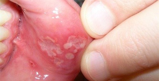 Không phải đường tình dục, đây mới là những đường lây nhiễm bệnh sùi mào gà không thể ngờ nhất - Ảnh 4.