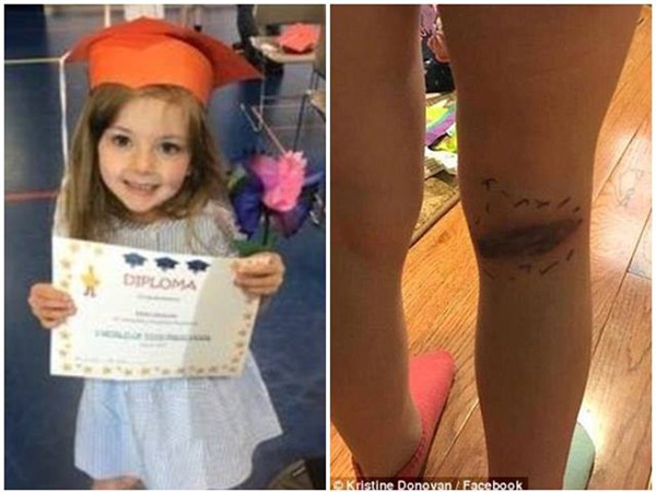 bo me ta hoa khi phat hien su that dang sau vet tham tim o chan con gai 5 tuoi - 1