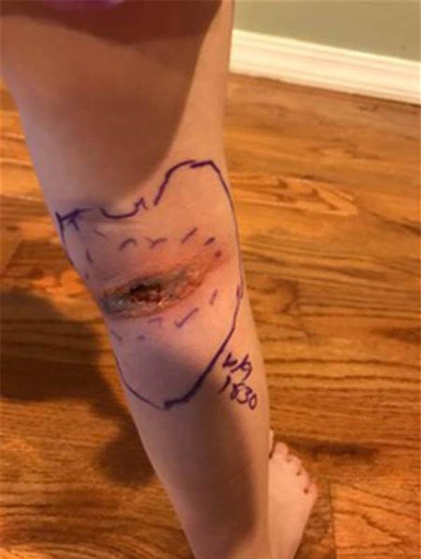 bo me ta hoa khi phat hien su that dang sau vet tham tim o chan con gai 5 tuoi - 2