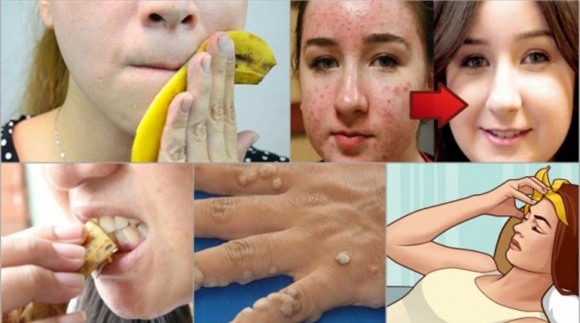 vỏ chuối, chữa bệnh từ quả, sức khỏe