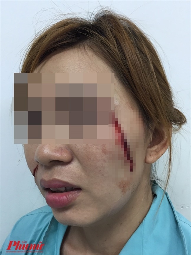 Tu choi tinh yeu, co gai bi chem hai nhat vao mat