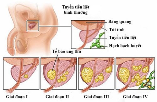 ung thư, bệnh ung thư, ung thư tuyến tiền liệt