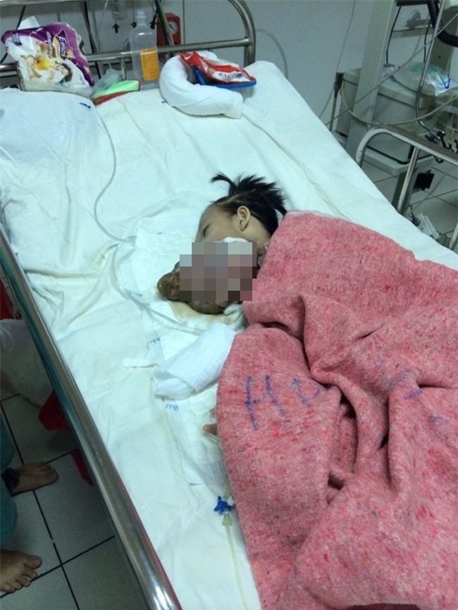 Chuỗi ngày đau đớn của bé gái 11 tuổi, mồ côi cha, bị khối u quái ác che kín mặt - Ảnh 3.