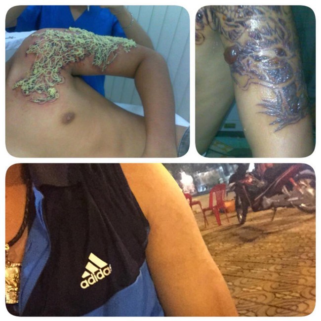 Dân mạng phát khiếp với hình ảnh xóa xăm đầy đau đớn của 9x Sài thành - Ảnh 5.