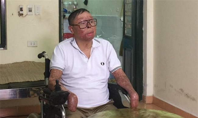 Chiến sỹ sống sót vụ máy bay rơi Hòa Lạc: Có hiến cho tôi tay thật cũng khó ghép nổi - Ảnh 1.