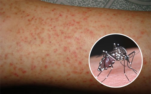 sốt xuất huyết,dịch bệnh,bệnh truyền nhiễm