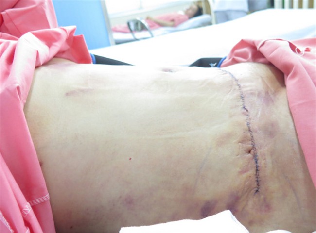 Coi chung mat mang khi hut mo, cat da thua vung bung hinh anh 1