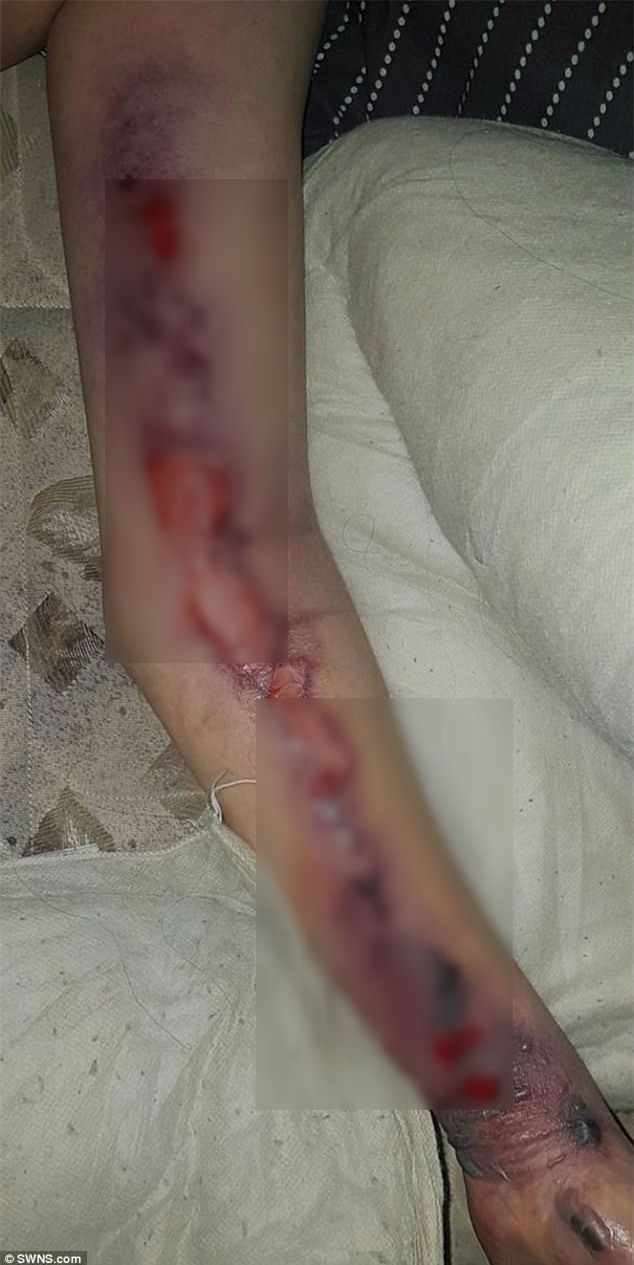 “Đổi gió” với bạn trai theo cách lạ, người phụ nữ trẻ mất mạng oan uổng vì vi khuẩn ăn thịt người - Ảnh 3.