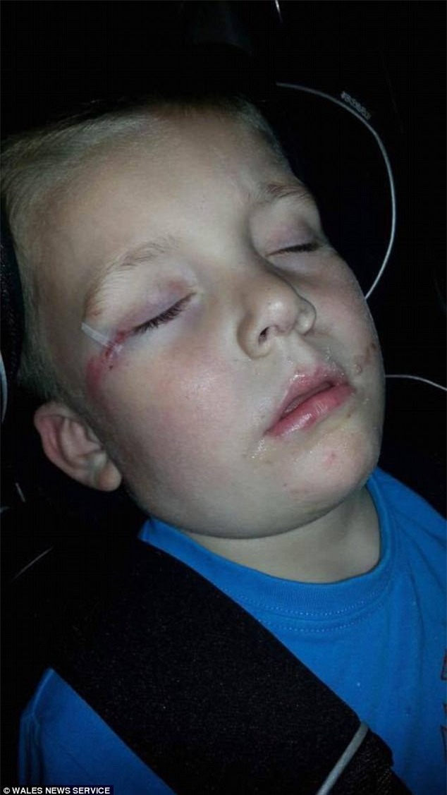 Chỉ sau một cú té, cậu bé 4 tuổi suýt mù và thậm chí mất mạng vì bị nhiễm vi khuẩn ăn thịt người - Ảnh 1.