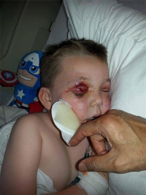Chỉ sau một cú té, cậu bé 4 tuổi suýt mù và thậm chí mất mạng vì bị nhiễm vi khuẩn ăn thịt người - Ảnh 2.
