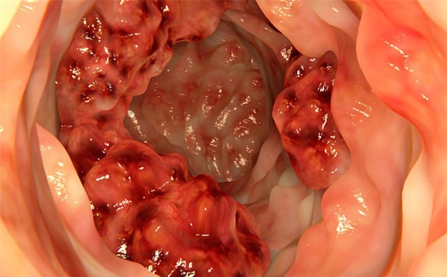 Cái chết bắt nguồn từ đại tràng: Rửa sạch độc tố trong đại tràng chỉ bằng cách ăn uống