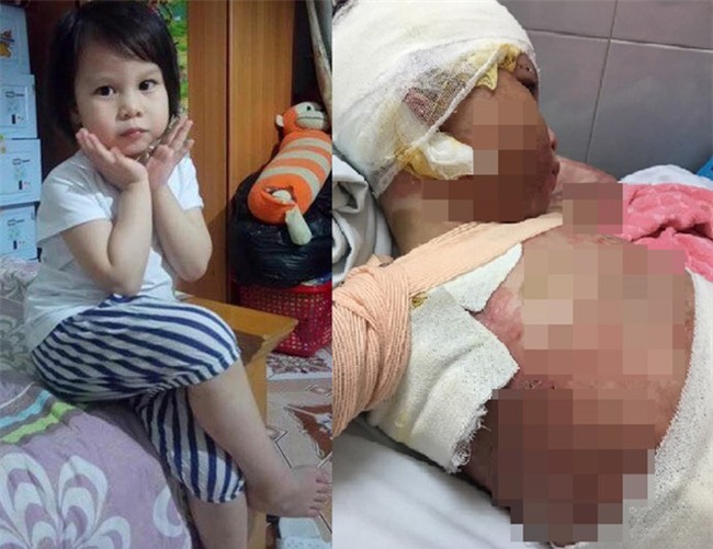 Co the bien dang cua be gai 5 tuoi bi bong con toan than hinh anh 1