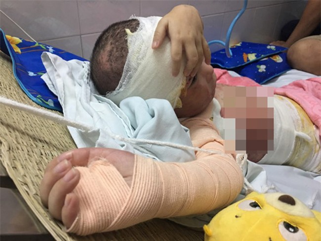 Co the bien dang cua be gai 5 tuoi bi bong con toan than hinh anh 2