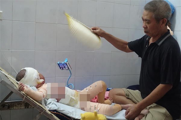 Co the bien dang cua be gai 5 tuoi bi bong con toan than hinh anh 3