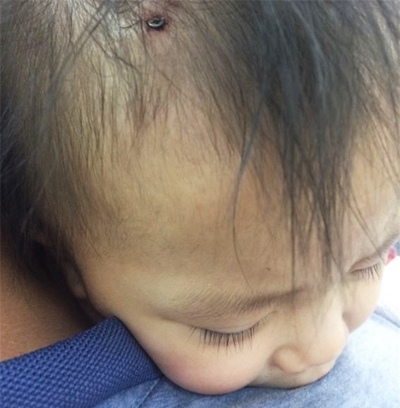 Qua nhà bạn hàng xóm chơi, bé gái 19 tháng tuổi bị cây đinh bén ghim vào đầu - Ảnh 1.