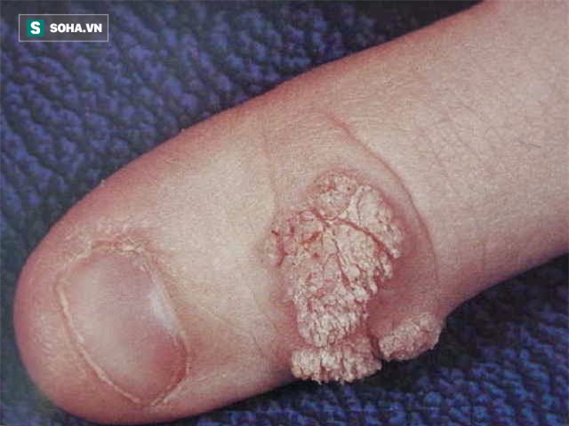 Bác sĩ khuyến cáo dùng chung khăn tắm cũng có thể lây sùi mào gà - Ảnh 1.