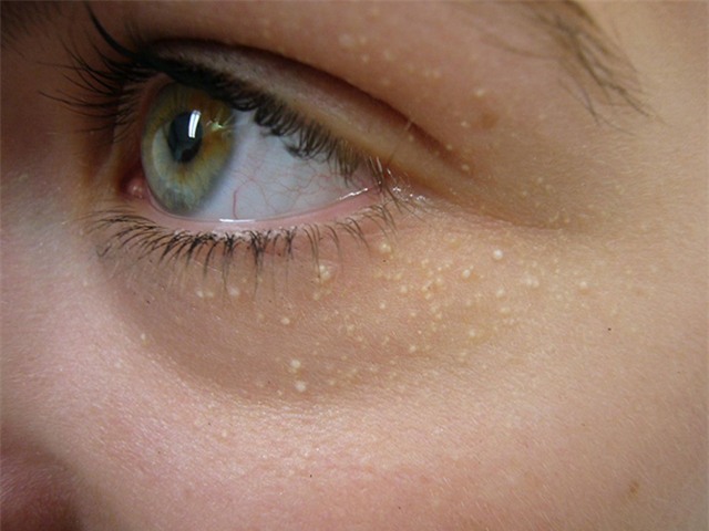 voi 2 ngan dong co ngay 2 cach tri mun thit quanh mat "mot di khong tro lai" - 1