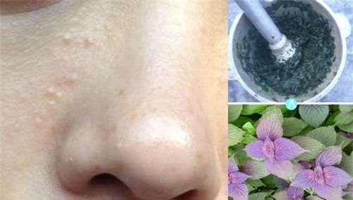 voi 2 ngan dong co ngay 2 cach tri mun thit quanh mat "mot di khong tro lai" - 4