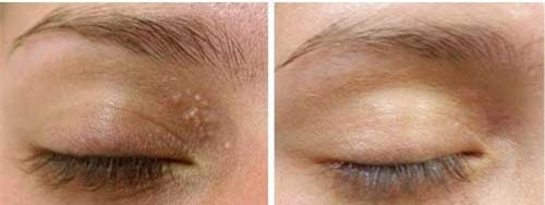 voi 2 ngan dong co ngay 2 cach tri mun thit quanh mat "mot di khong tro lai" - 8