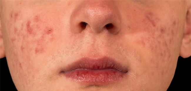 7 vấn đề về da bạn không bao giờ được lờ đi nếu không sẽ càng nghiêm trọng - Ảnh 2.