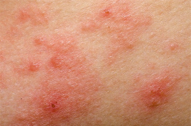 7 vấn đề về da bạn không bao giờ được lờ đi nếu không sẽ càng nghiêm trọng - Ảnh 4.