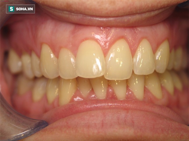 6 điều tồi tệ có thể xảy ra với cơ thể nếu bạn uống nước có ga mỗi ngày - Ảnh 1.