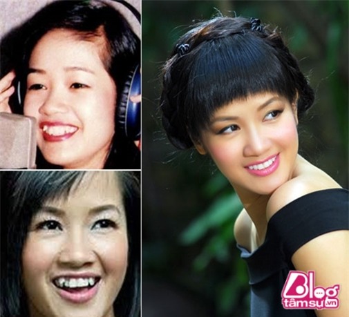 thanh-bi-mai-rang-blogtamsuvn11