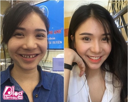 thanh-bi-mai-rang-blogtamsuvn2