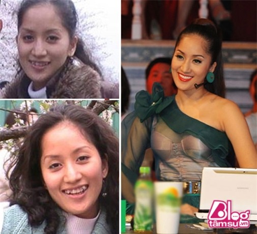 thanh-bi-mai-rang-blogtamsuvn4