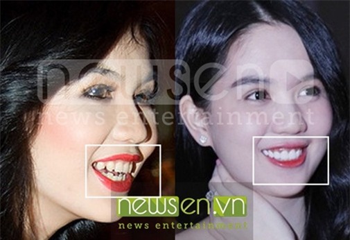 thanh-bi-mai-rang-blogtamsuvn8