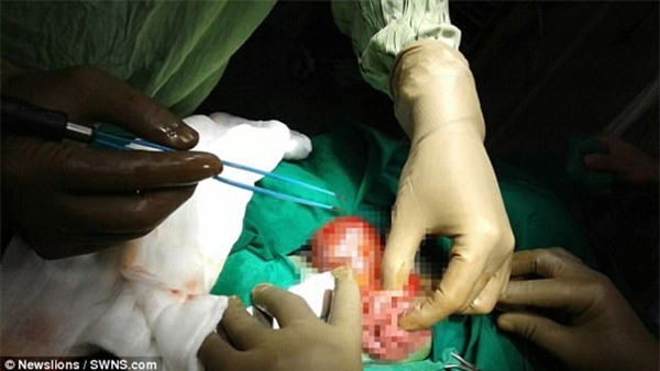 ky la: be trai vua chao doi da "mang thai" nguoi anh em song sinh - 3