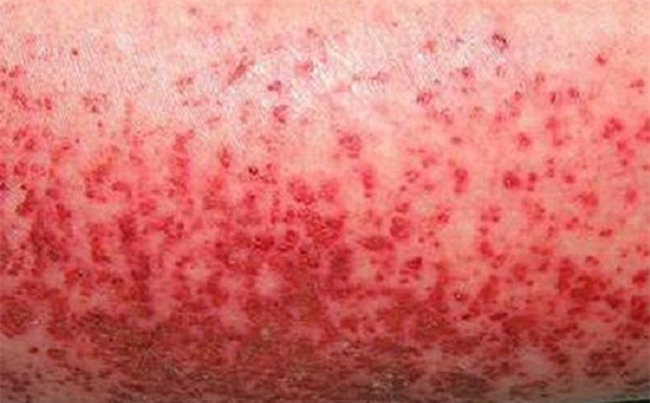 Dấu hiệu trẻ bị sốt xuất huyết và những cảnh báo nguy hiểm