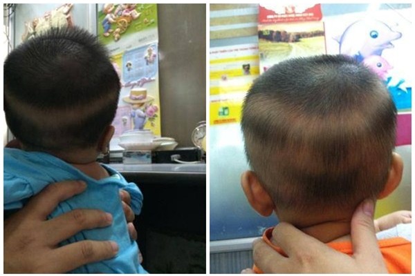 cach dieu tri rung toc vanh khan o tre nho don gian va chuan nhat theo bac si tu van - 1