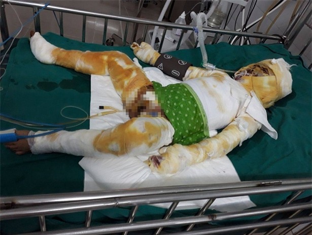 Xót xa hoàn cảnh bé trai sang hàng xóm xem nướng mực bị cồn thiêu như đuốc, hoại tử 2 chân - Ảnh 3.