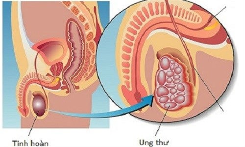 bệnh ung thư, ung thư