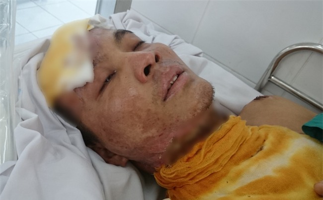 Chàng sinh viên điển trai đi làm thêm không may bị điện giật, hoại tử cơ thể