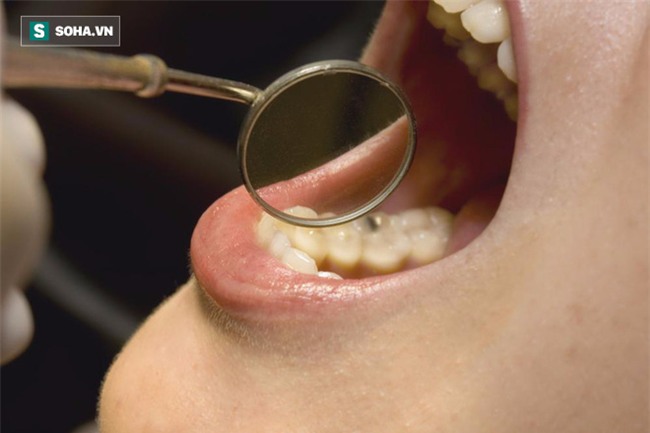 Những dấu hiệu ở răng cảnh báo nguy cơ ung thư: Thêm một lí do phải đánh răng sạch - Ảnh 1.